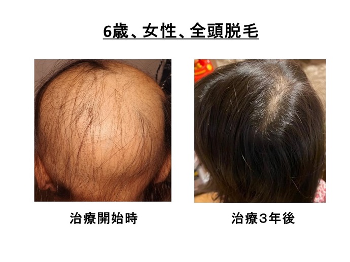 円形脱毛症　病院